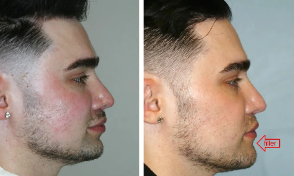 Clinical photo from Chad's cosmetic jaw surgery case